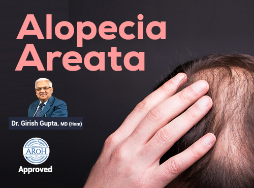 Webinar on Alopecia Areata